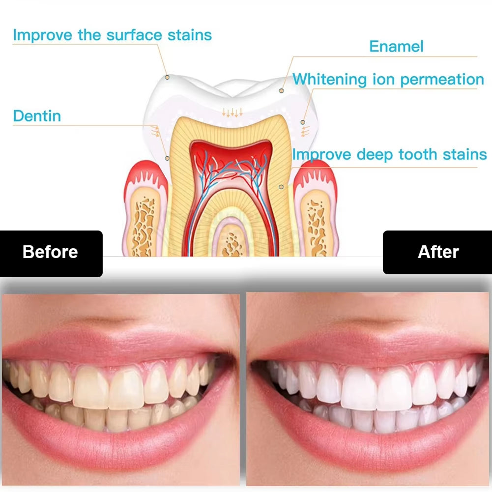 Title BriteAvi Professional LED Teeth Whitening Kit with 35% Carbamide Peroxide
