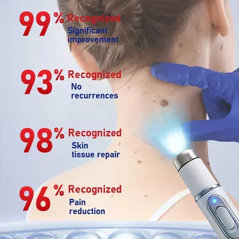 TalfMous Blue Light Technology For Chemical-Free Safe Wart Removal Treatment