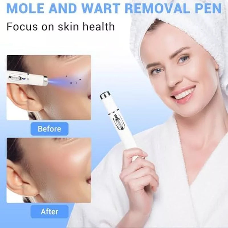 TalfMous Blue Light Technology For Chemical-Free Safe Wart Removal Treatment
