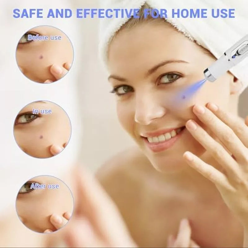 TalfMous Blue Light Technology For Chemical-Free Safe Wart Removal Treatment